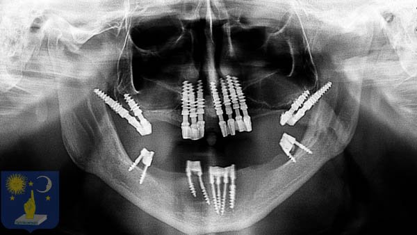implant-basal-résultat-après